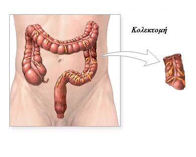 colon6