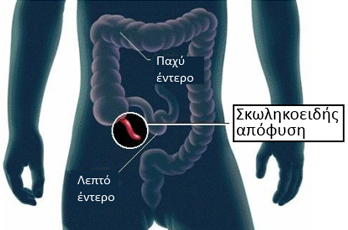 Σκωληκοειδεκτομή